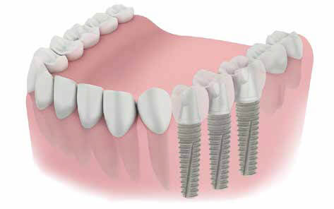 SLV Implants Systems - Surgical Kit